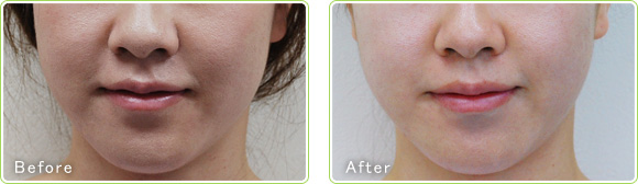 Before-After